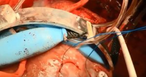 Robot Peremas Jantung Menakjubkan Ini Menjaga Pemompaan Darah Pada Organ yang Rusak