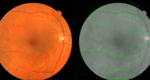 Google AI Bisa Memprediksi Penyakit Jantung dengan Melihat Gambar Retina