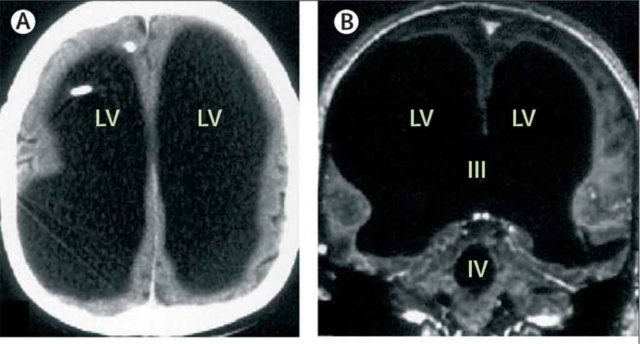 Misteri Pria yang Telah Hidup Normal Tanpa 90% Otak