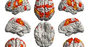 Musik Mengaktifkan Daerah otak yang terhindar dari penyakit Alzheimer